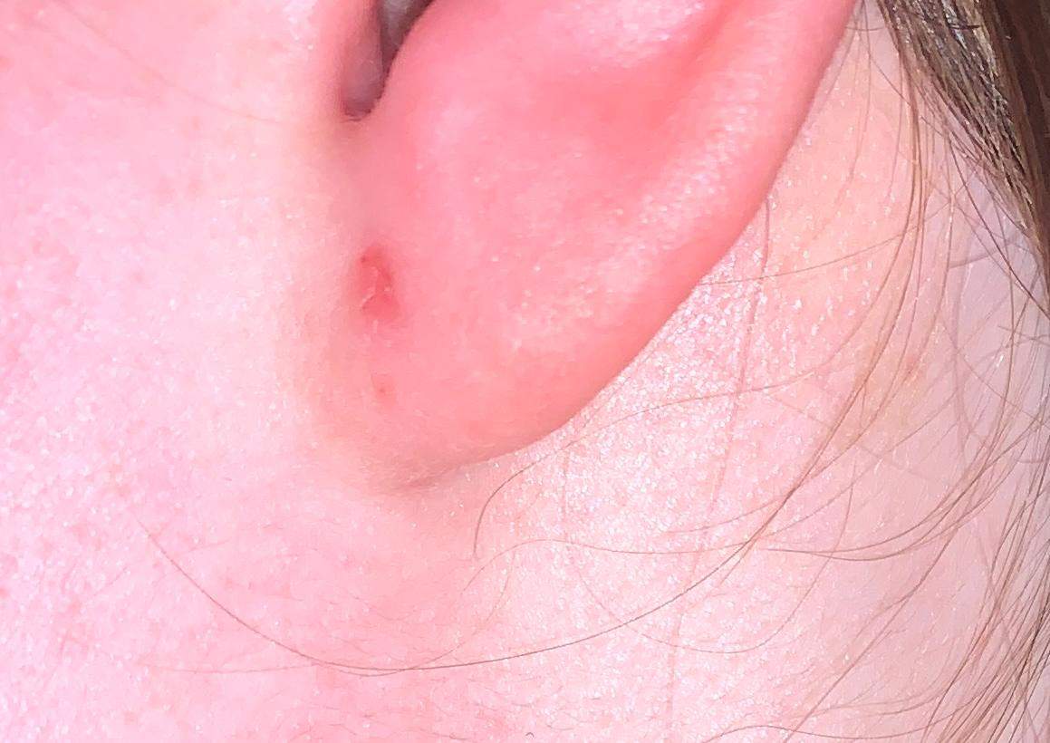 Warum ist mein Ohrloch so entzündet?