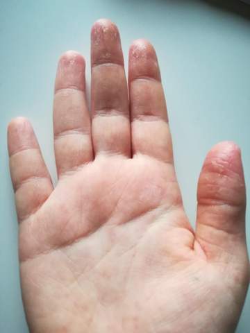 Warum schält sich meine Haut an den Fingerkuppen ab? (Hand, Hautprobleme, trockene Haut)