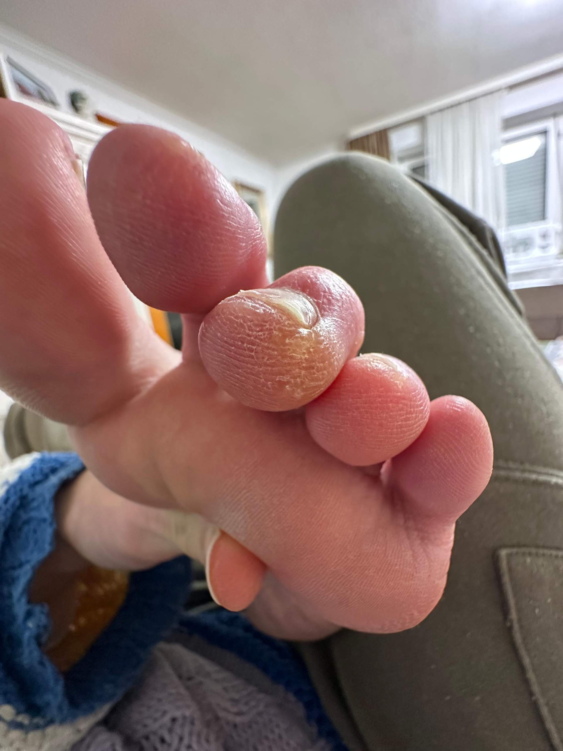 Warum sind meine Füße so hässlich? (Zeh, nägel, Schuhe)
