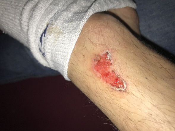 Warum Verheilt Meine Wunde Nicht Heilung Warum Verheilt Meine Wunde Nicht Heilung