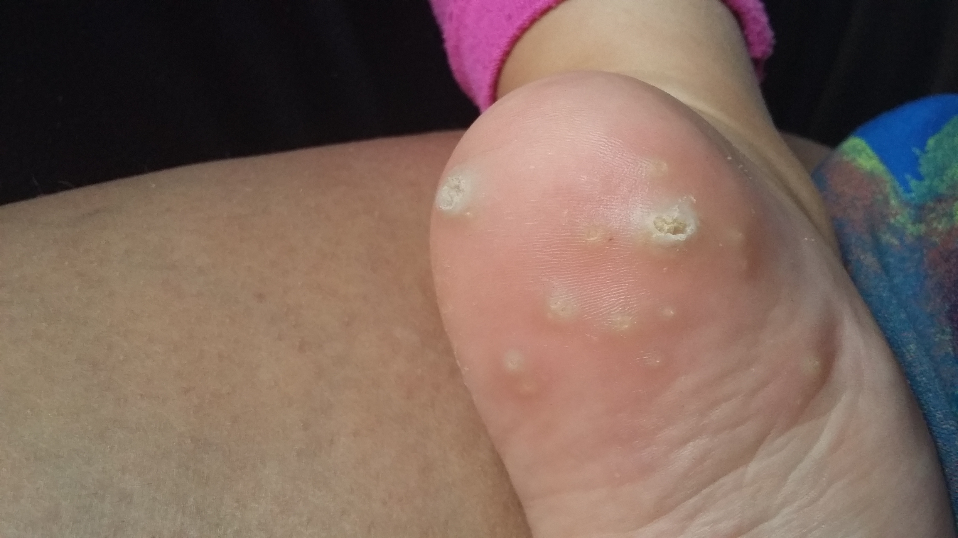 Warze ? (hautarzt, Warzen) Warze ? (hautarzt, Warzen)