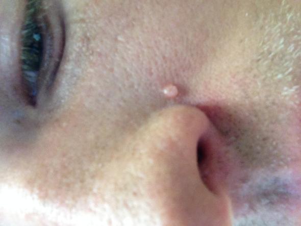 Warze Im Gesicht Hautarzt Warzen Warze Im Gesicht Hautarzt Warzen
