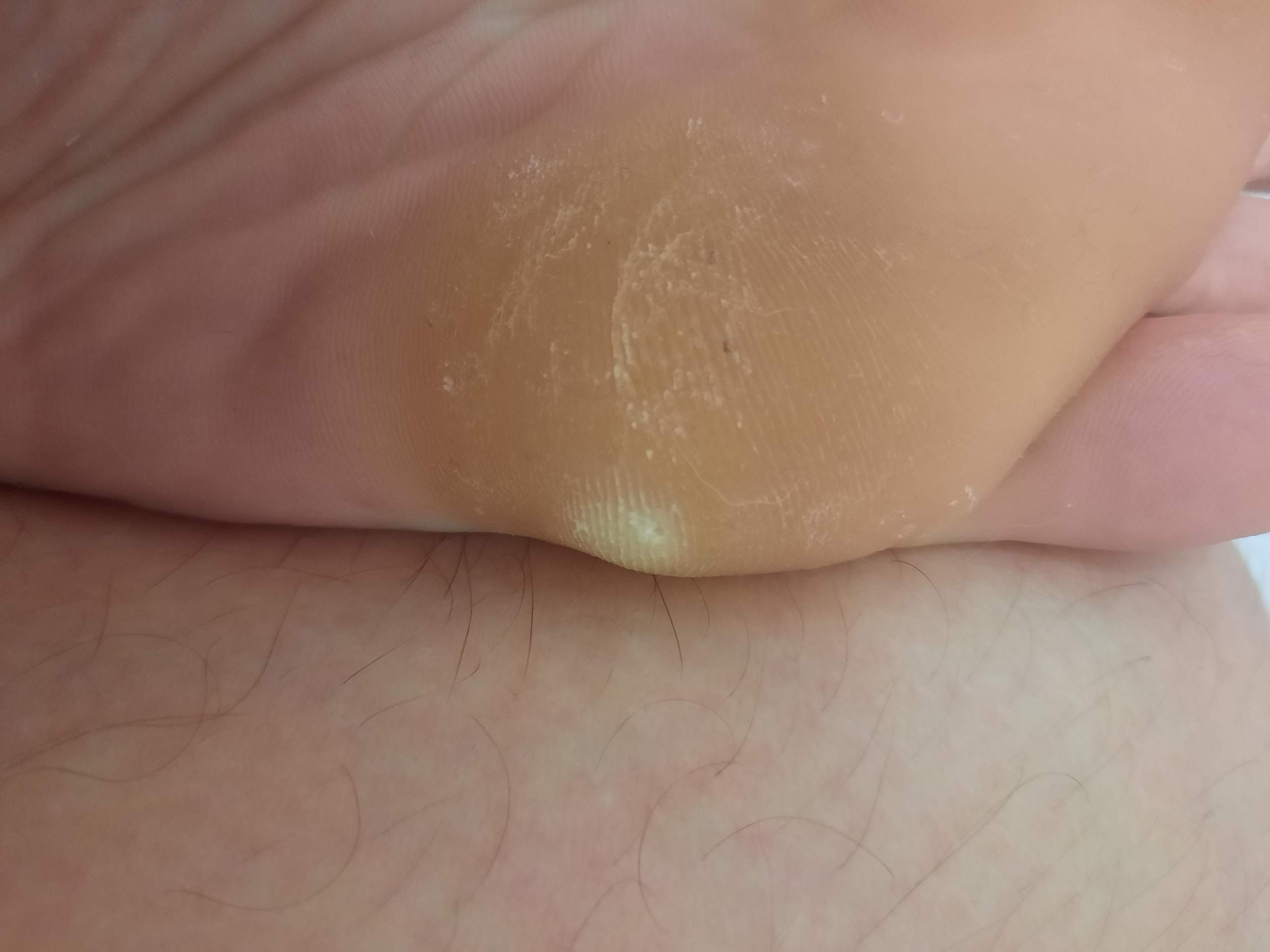 Warze oder Hühnerauge? (Haut, Warzen) Warze oder Hühnerauge? (Haut, Warzen)