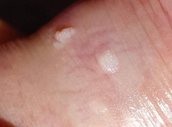 Hinten vorhaut Vorhaut hinten