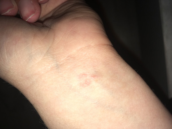 Warzenahnliche Knubbel Haut Krebs Warzenahnliche Knubbel Haut Krebs