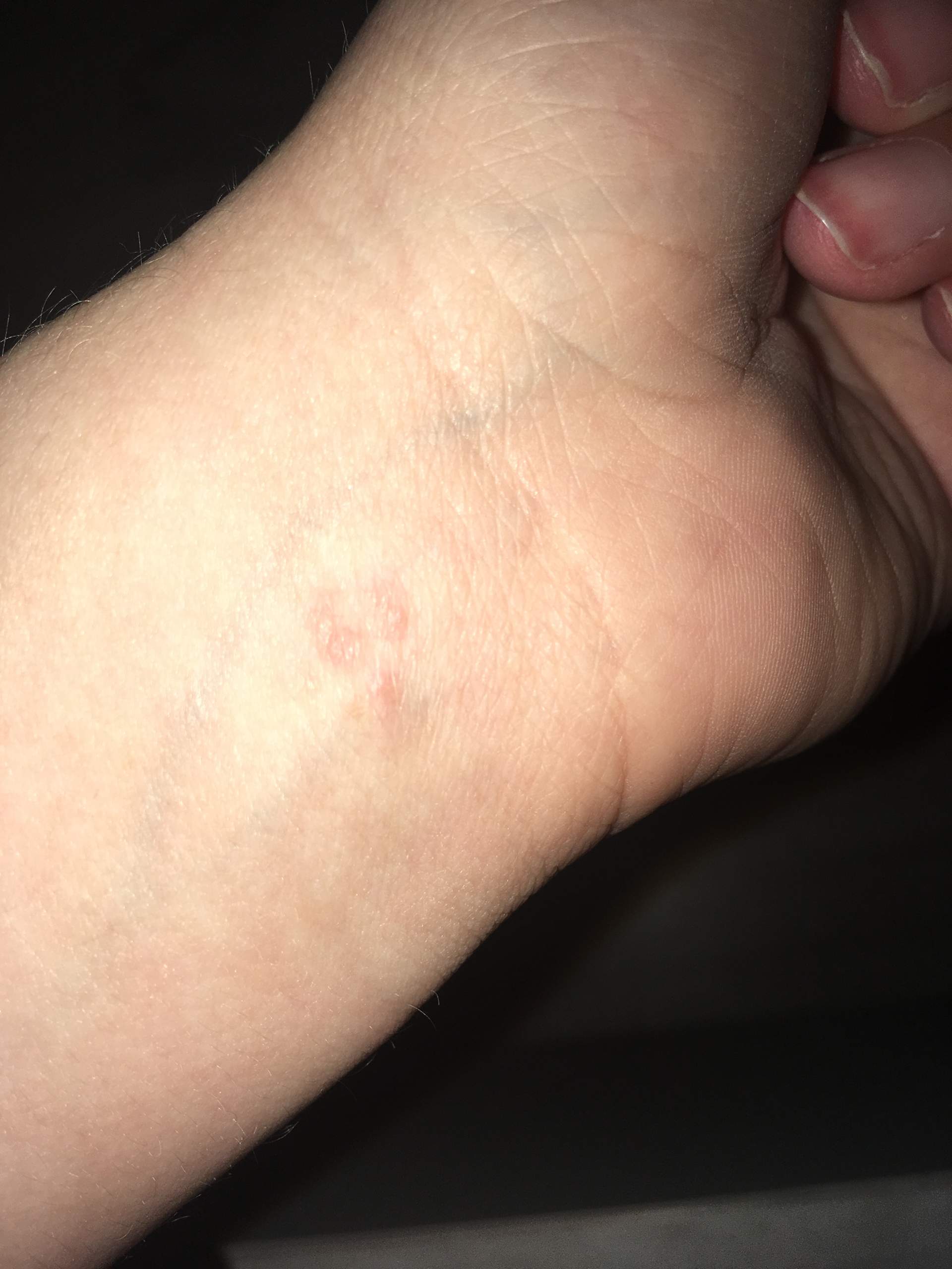 Warzenahnliche Knubbel Haut Krebs Warzenahnliche Knubbel Haut Krebs