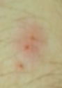 Stiche - (Stich, Insekten)