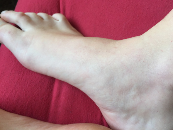 Rechter Fuß  - (Haut, Leukämie)