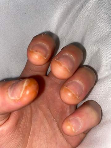 Was ist da an meinen Fingern  meine Finger fühlen sich taub an?