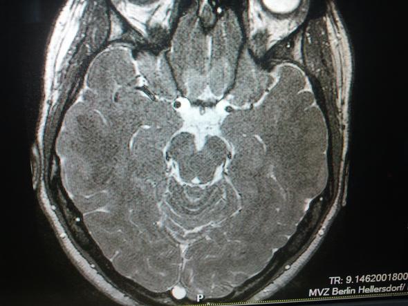 Kleiner weißer Punkt im hinteren Bereich - (MRT, Gehirn, Tumor)
