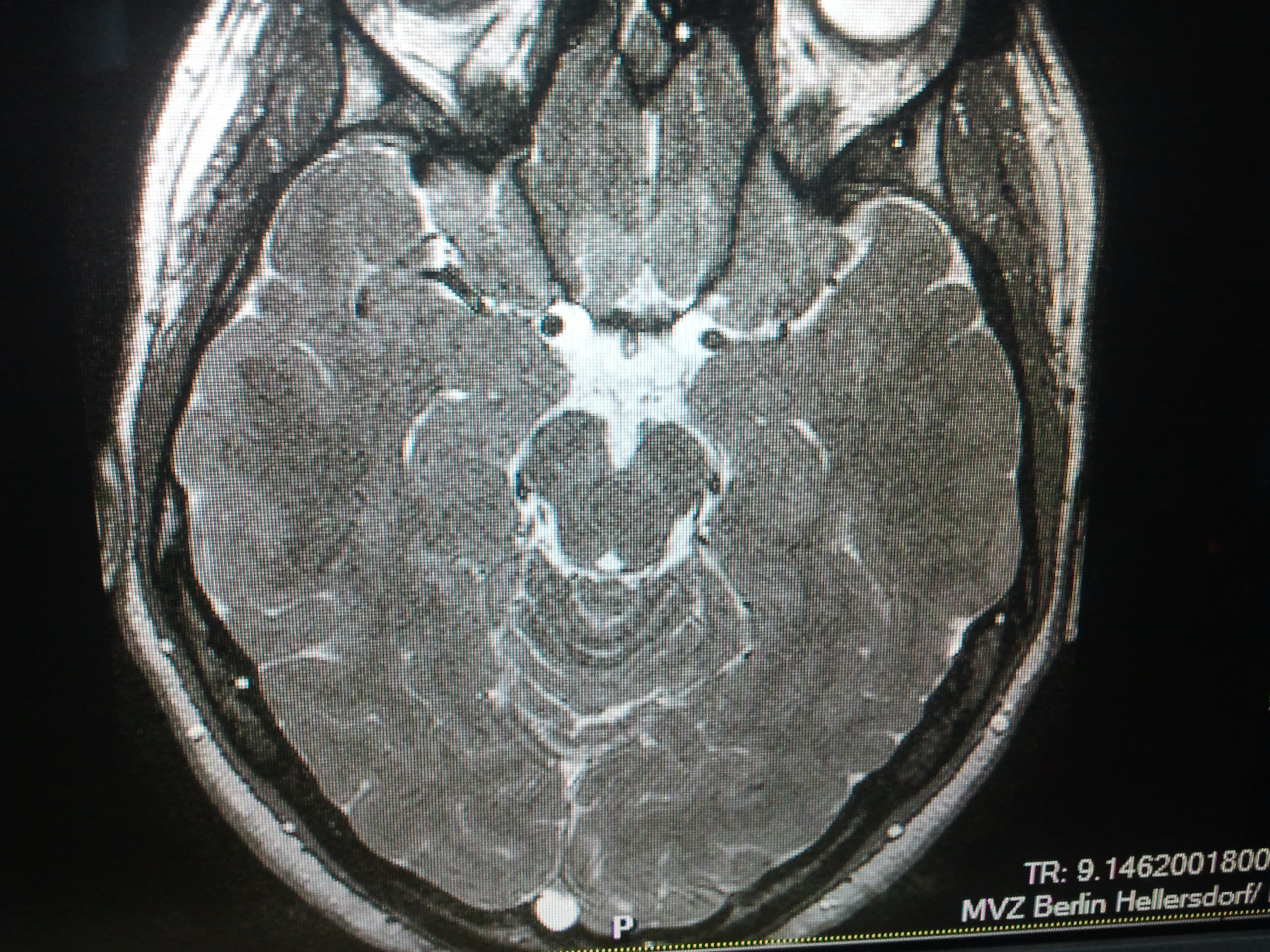 Was ist das ??? Tumor ?? (MRT, Gehirn)