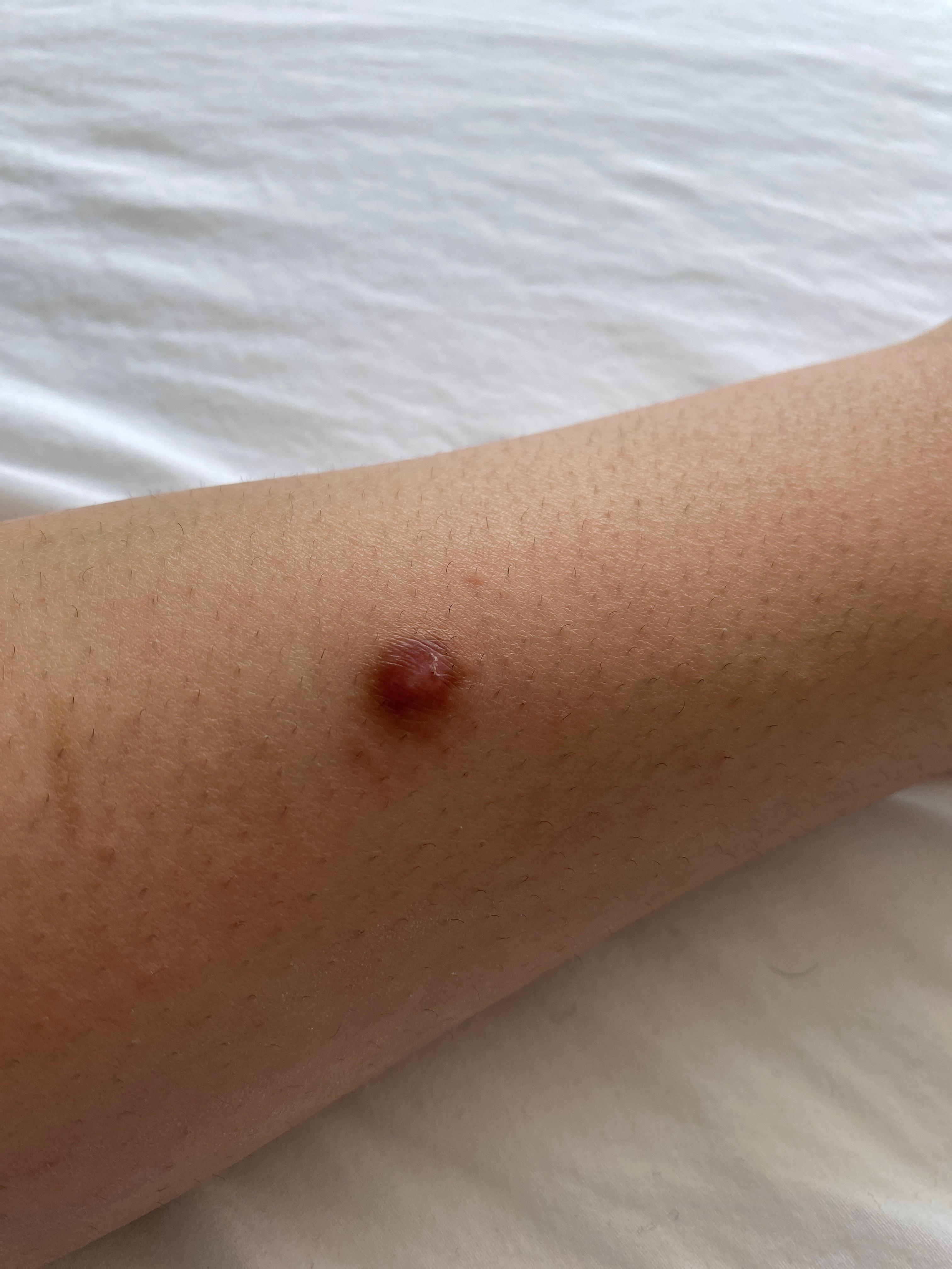 Was ist das an meinem Arm? (Krankheit, Flecken, rote Flecken) Was ist das an meinem Arm? (Krankheit, Flecken, rote Flecken)