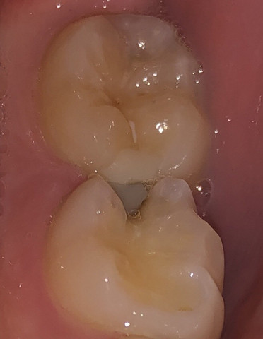 Was ist das an meinem Zahn?