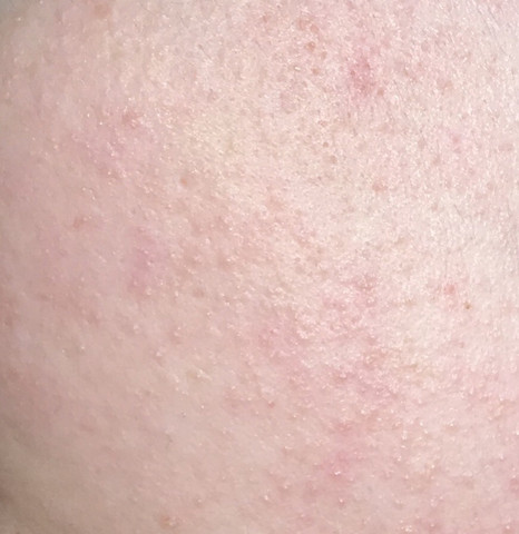 Was Ist Das Auf Meinen Wangen Haut Gesundheit Gesicht Was Ist Das Auf Meinen Wangen Haut Gesundheit Gesicht