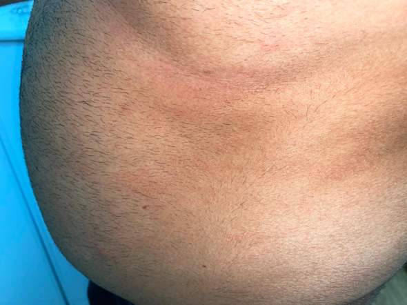 Was ist das Ausschlag am bauch? Was ist das Ausschlag am bauch?