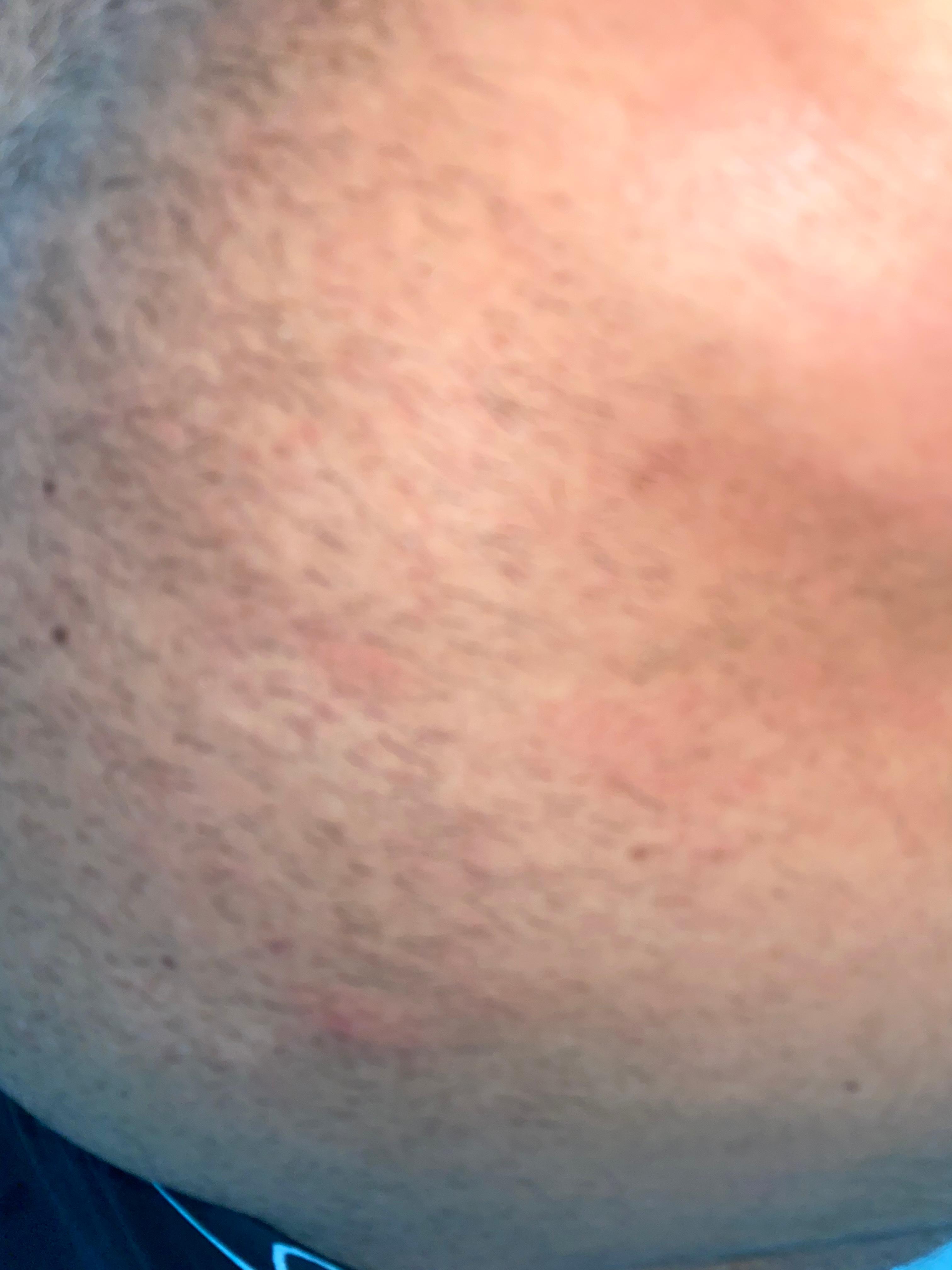 Was ist das Ausschlag am bauch? Was ist das Ausschlag am bauch?