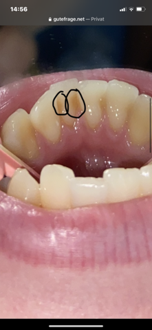 Was ist das Braune an meinen Zähnen?