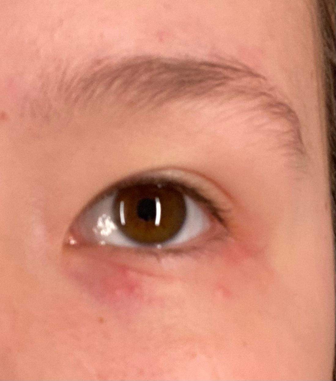 Was ist das für ein Ausschlag am Auge? (Haut, Dermatologie)