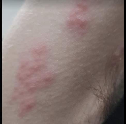 Was Ist Das Fur Ein Ausschlag Unter Meine Achseln Haut Juckreiz