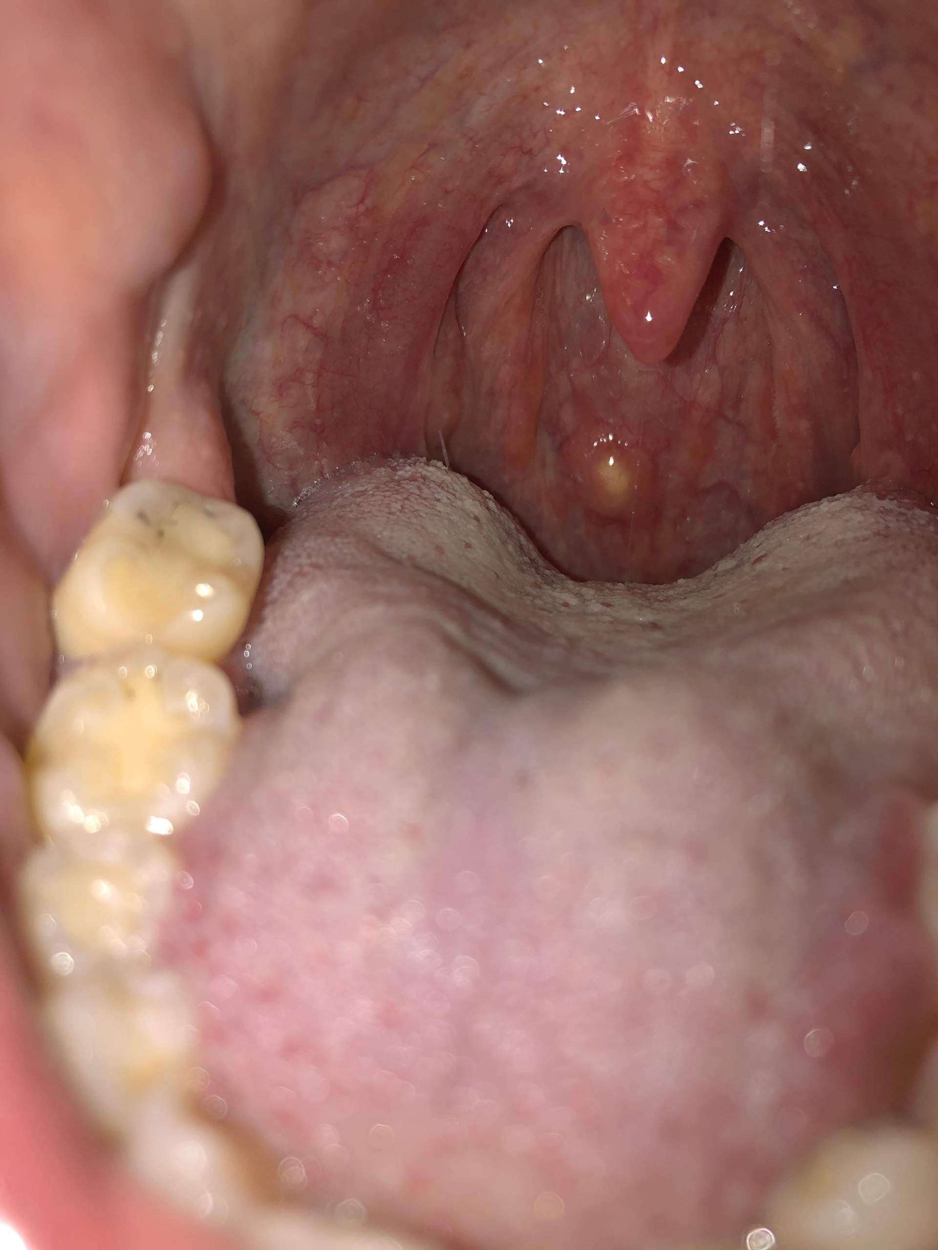 Was ist das für ein eitriger Knoten im Rachenraum? (Rachen)
