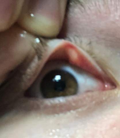 Was ist das für ein Knoten / Knubbel im Innenlid meines Auges?