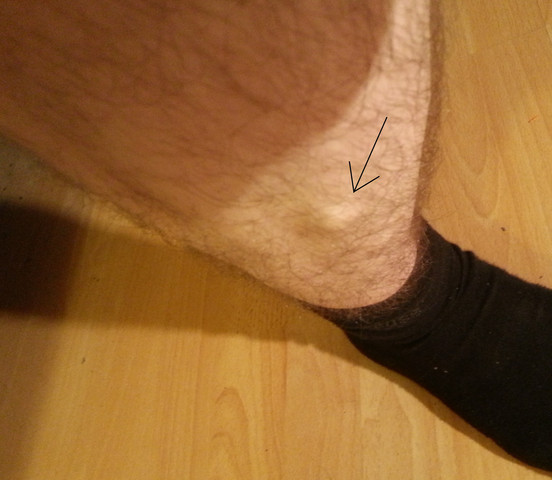 Was Ist Das Fur Ein Knubbel Am Schienbein Foto Belastung Was Ist Das Fur Ein Knubbel Am Schienbein Foto Belastung