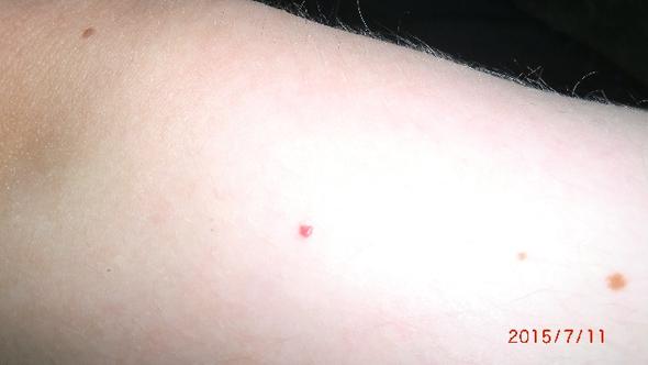 roter Leberfleck 1 - (Haut, Leberfleck)
