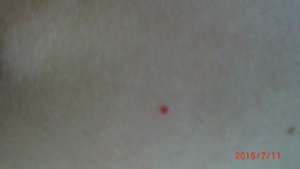 roter Leberfleck 2 - (Haut, Leberfleck)