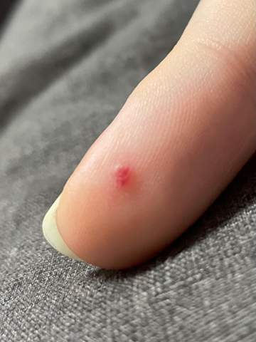 Was ist das für ein roter Punkt auf dem Finger?