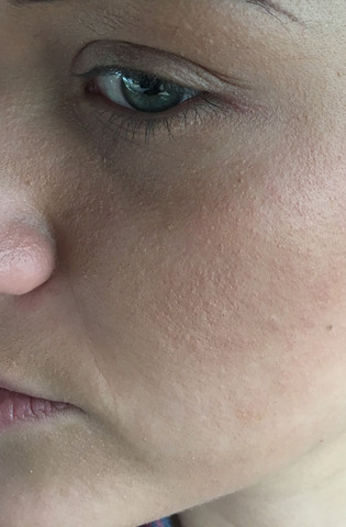 Ausschlag Gesicht  - (Haut, Ausschlag, Dermatologie)