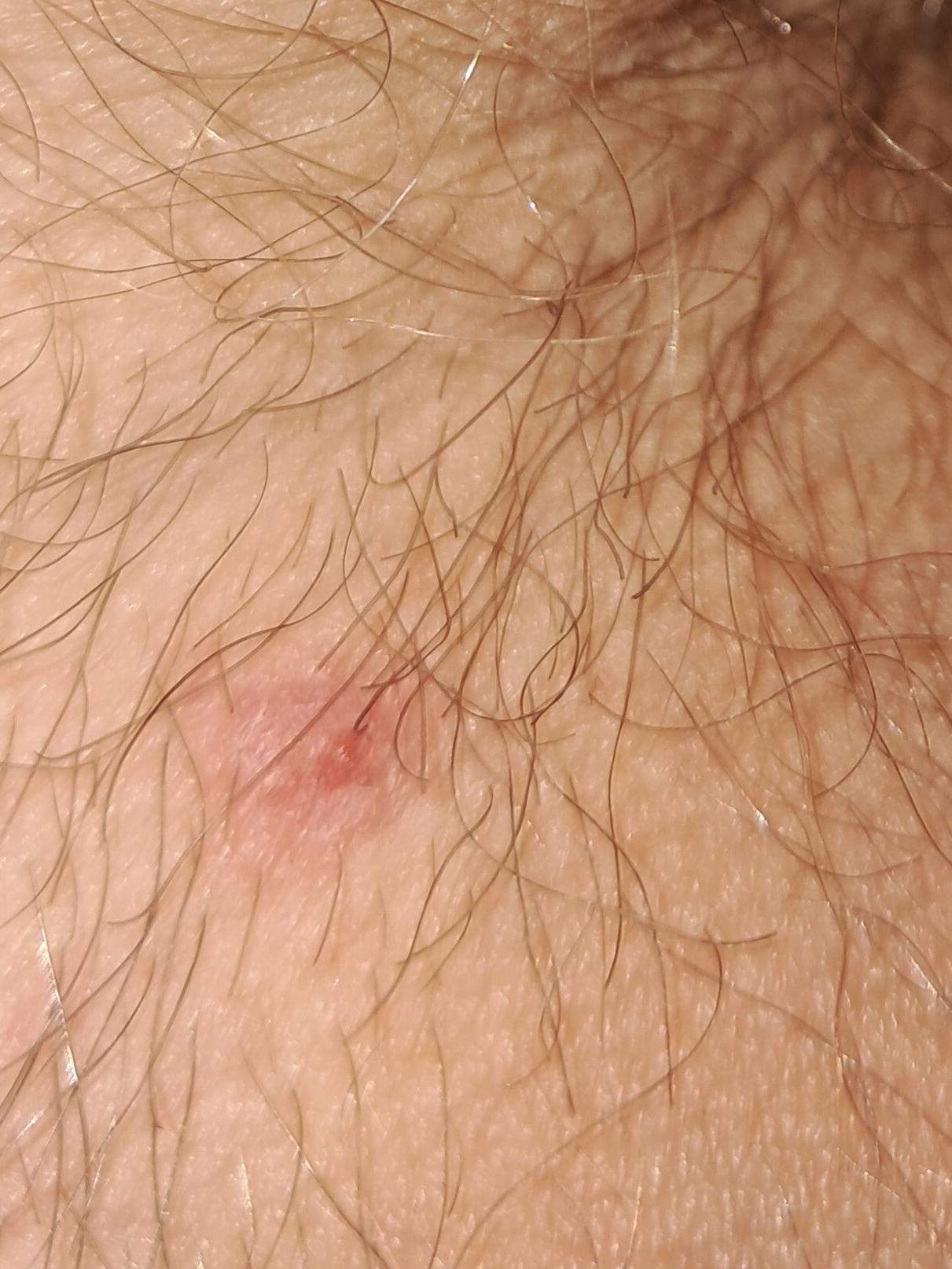 Was ist das muss ich mir sorgen machn? (Infektion, intimbereich)
