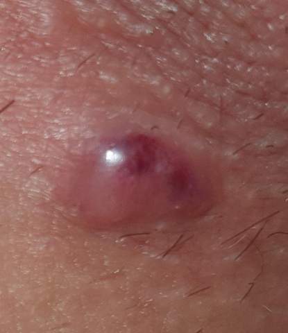 Karbunkel Im Intimbereich Karbunkel Im Intimbereich