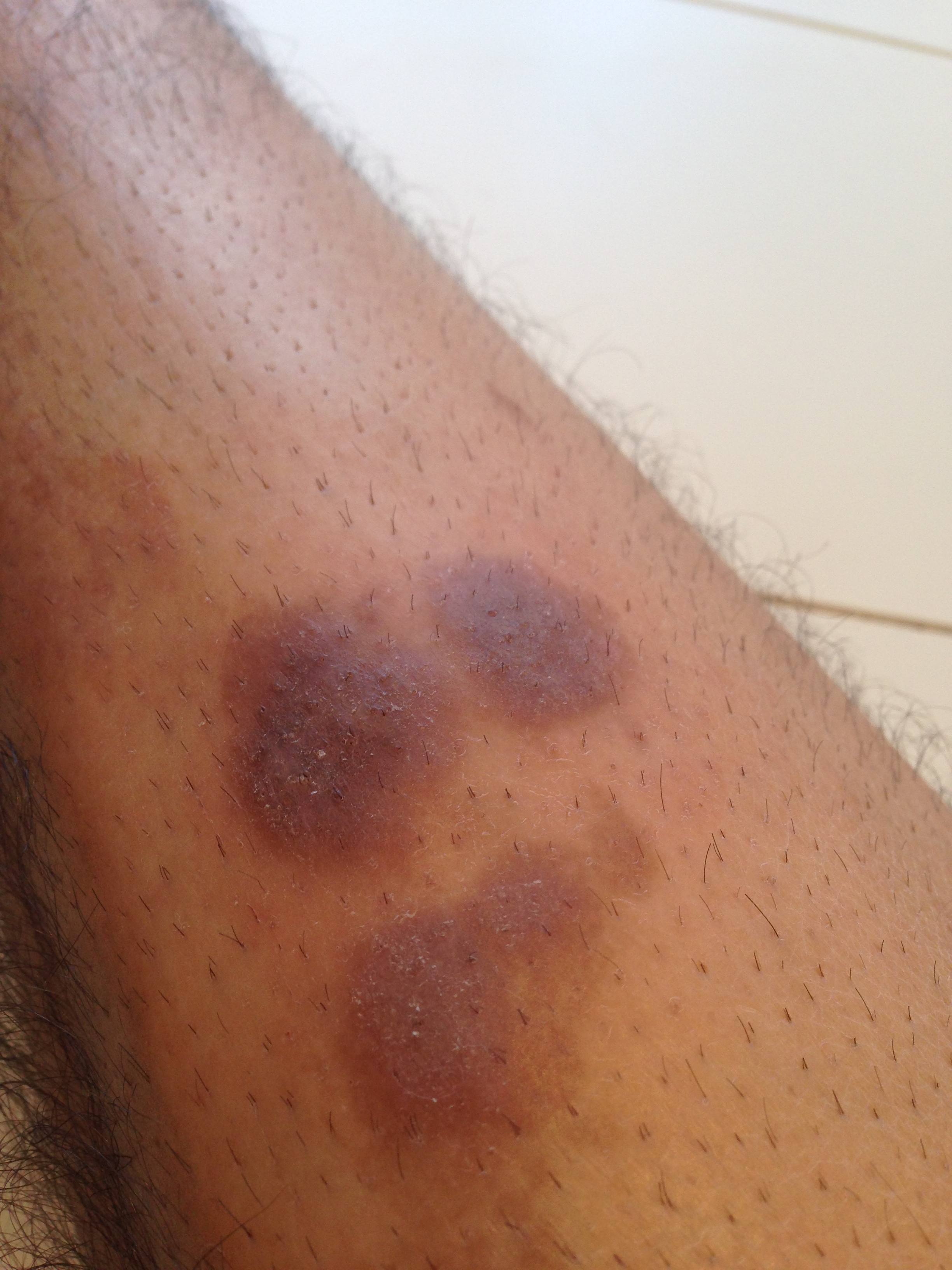 Was ist das, was ich am Bein/Unterschenkel hab (>Haut)? (trockene Was ist das, was ich am Bein/Unterschenkel hab (>Haut)? (trockene