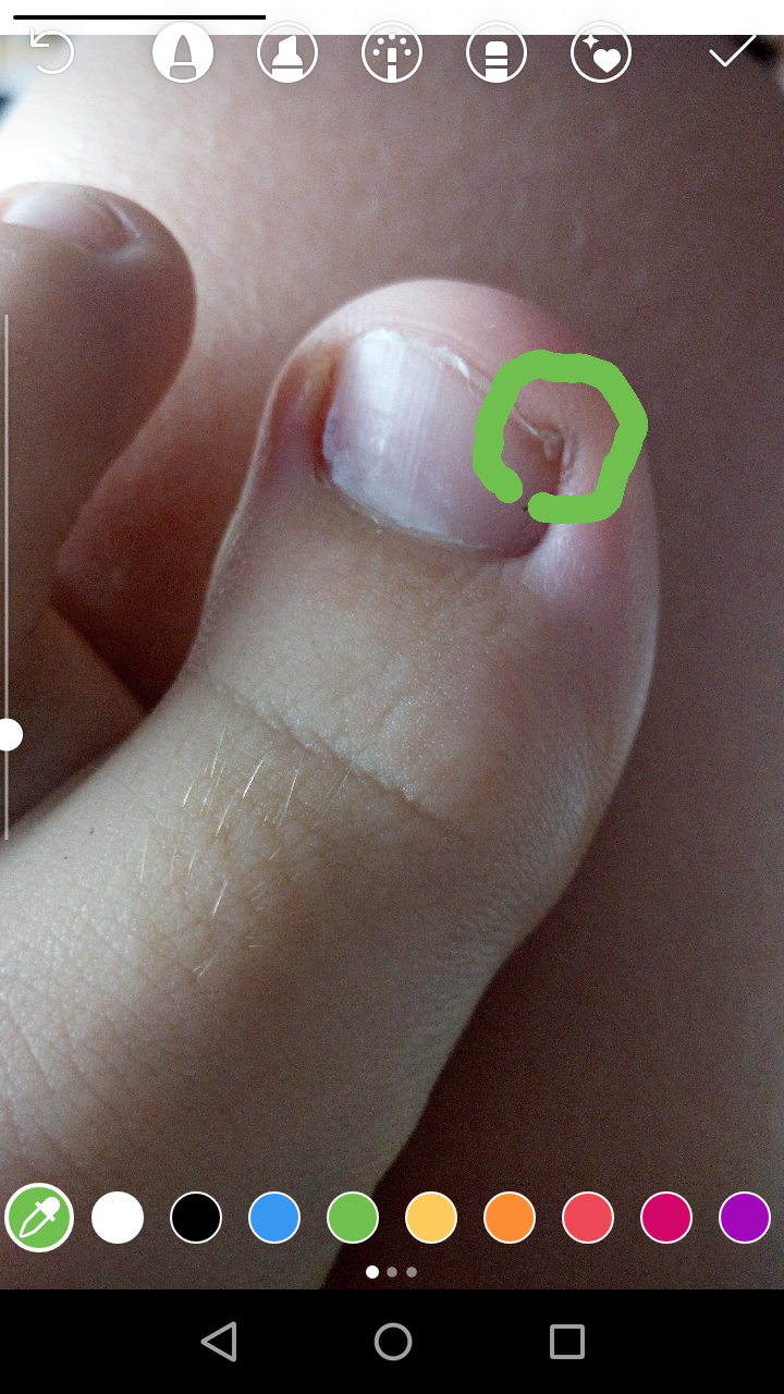 Eiter Im Finger Was Tun - mobinspire