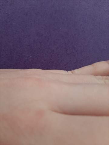 was ist falsch mit meinem kleinem finger?