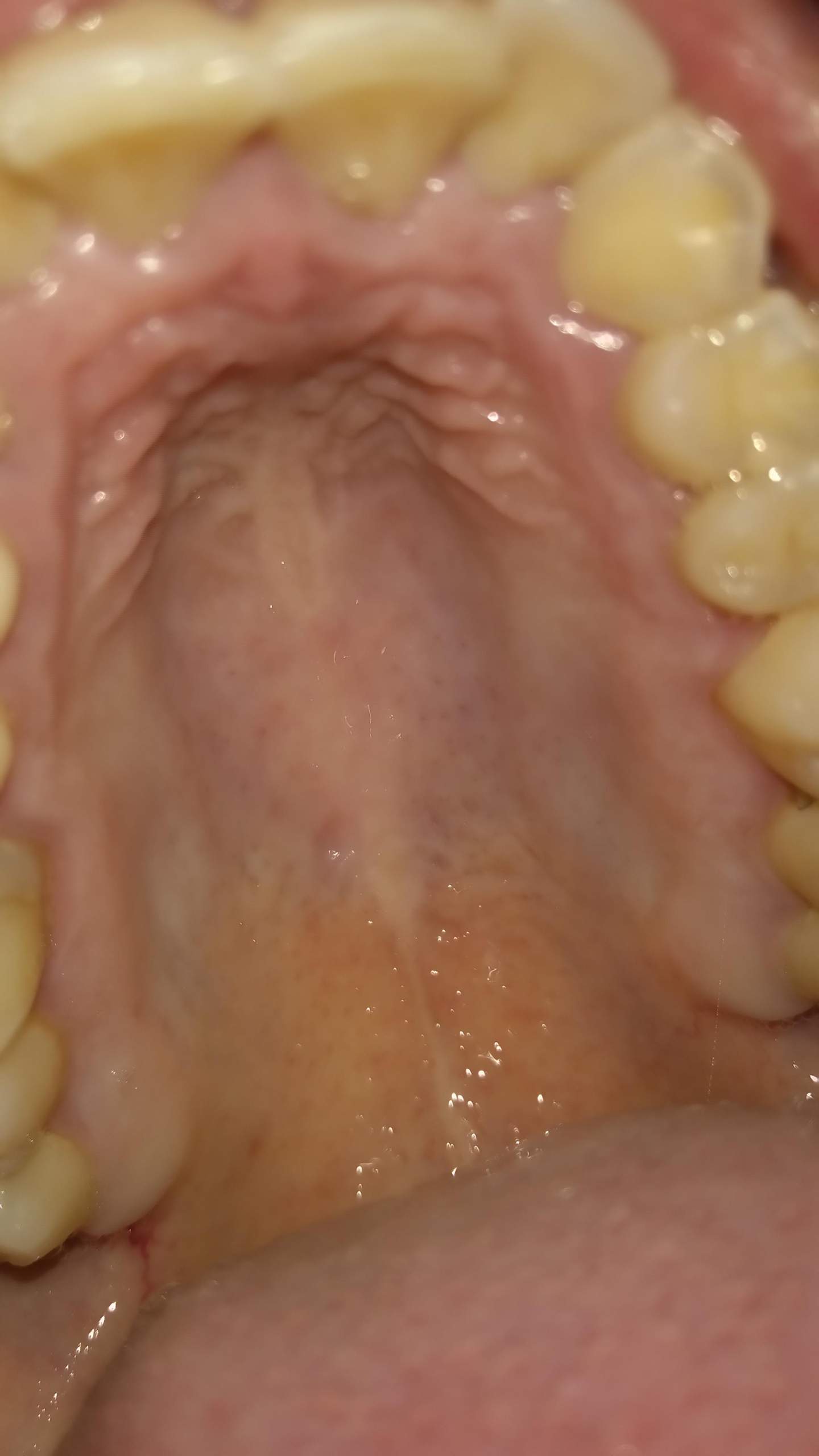 Was ist in meinem Mund und Rachenraum los? (Schmerzen, Rachen, Mundschleimhaut) Was ist in meinem Mund und Rachenraum los? (Schmerzen, Rachen, Mundschleimhaut)