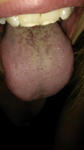 Was Ist In Meinem Mund Und Rachenraum Los Schmerzen Rachen Mundschleimhaut Was Ist In Meinem Mund Und Rachenraum Los Schmerzen Rachen Mundschleimhaut