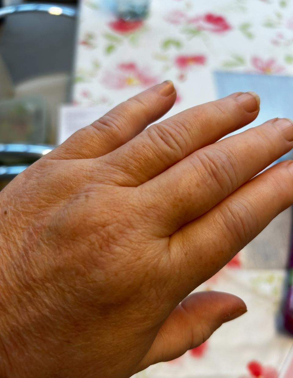 Was kann das sein, geschwollene Hände? (Krankheit, Hand)