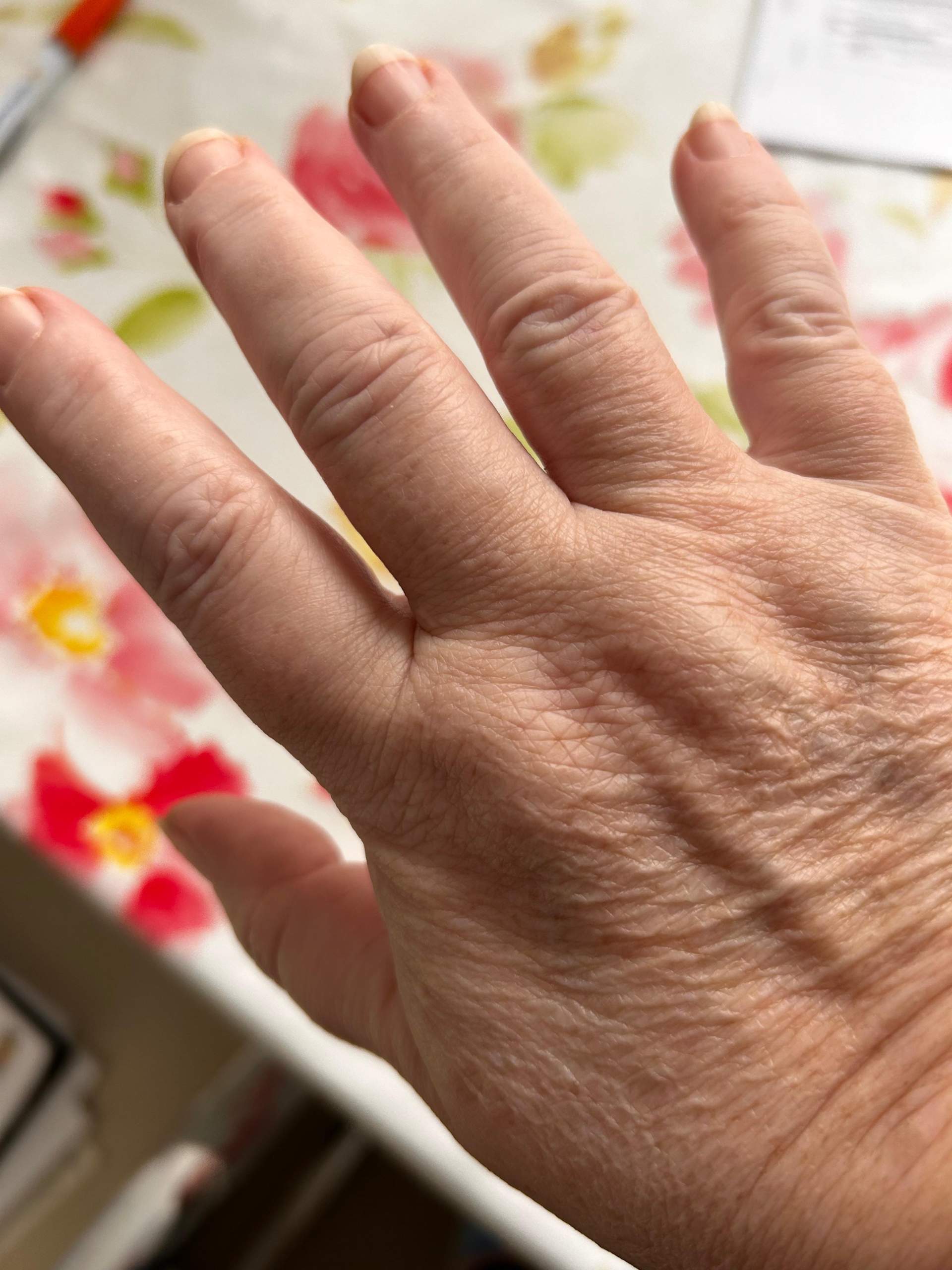 Was kann das sein, geschwollene Hände? (Krankheit, Hand)