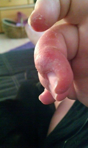 Finger1 - (Juckreiz, Finger, Hautprobleme)