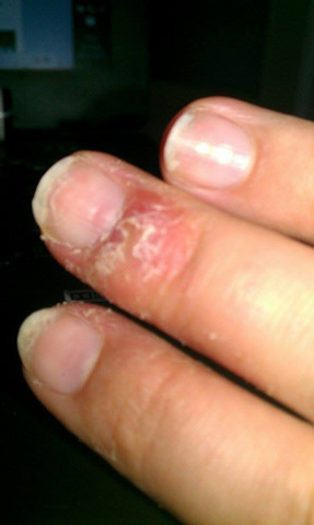 Finger3 - (Juckreiz, Finger, Hautprobleme)