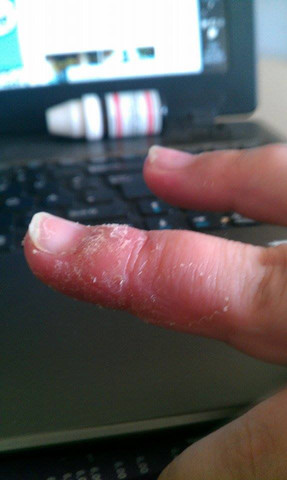 Finger4 - (Juckreiz, Finger, Hautprobleme)