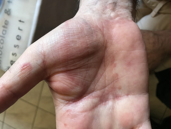 Was ist das - (Haut, Dermatologie, Pilze)