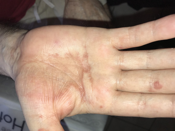 Was ist das - (Haut, Dermatologie, Pilze)