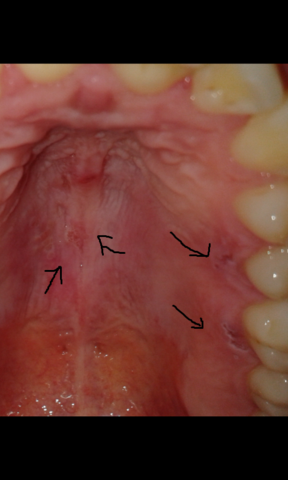Was Konnte Das Sein Offene Stellen Am Gaumen Mund Was Konnte Das Sein Offene Stellen Am Gaumen Mund