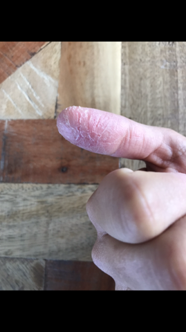 Was könnte diese Hautveränderung an den Fingern sein?