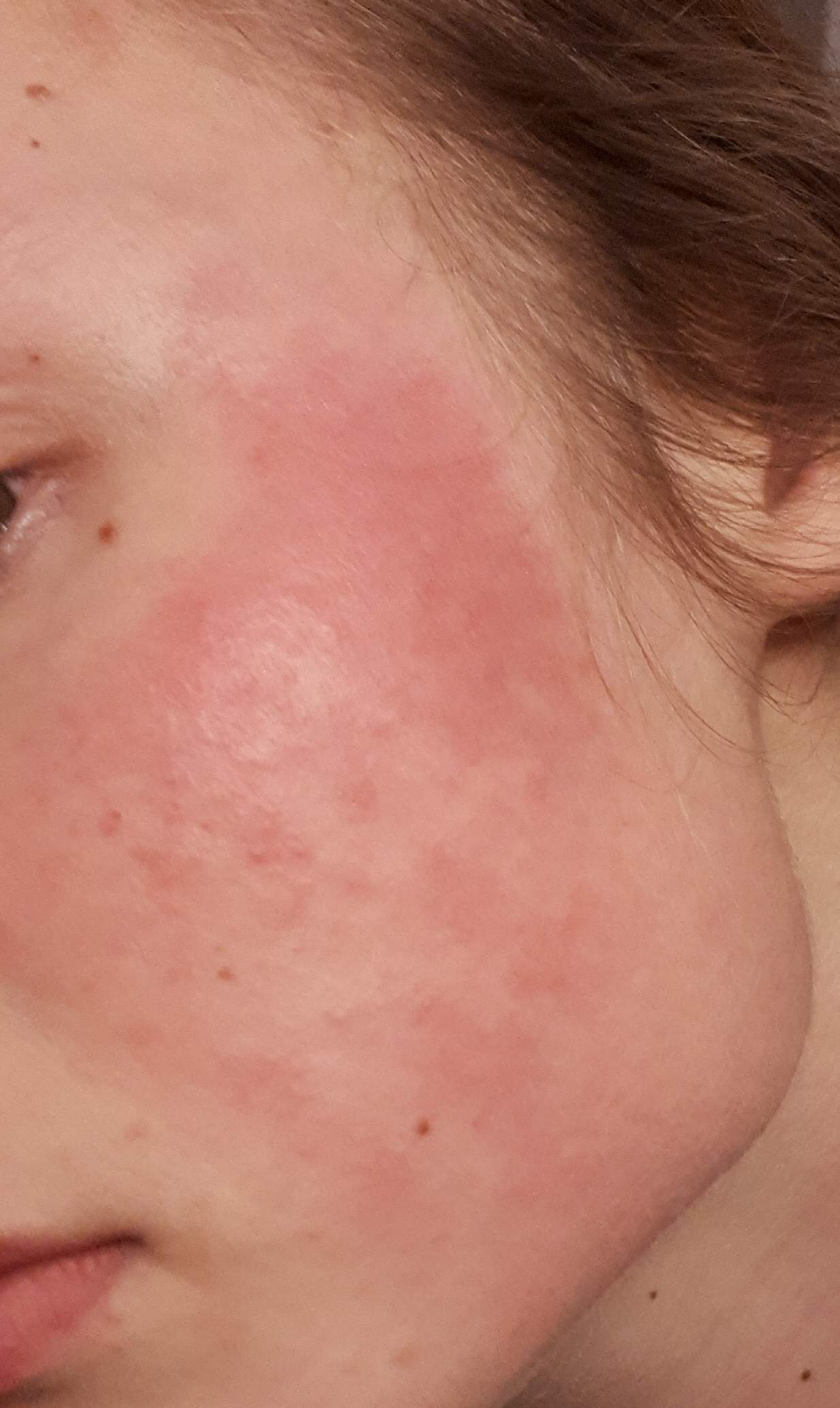 Was könnte es sein es brennt und ist extrem rot? (Haut, Dermatologie, hautarzt) Was könnte es sein es brennt und ist extrem rot? (Haut, Dermatologie, hautarzt)