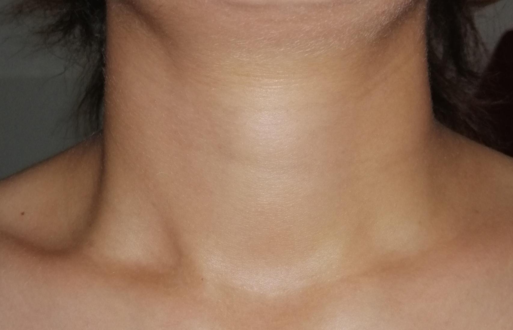 Was meint ihr oder iire ich mich? (Schwellung, Hals) Was meint ihr oder iire ich mich? (Schwellung, Hals)