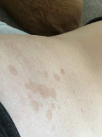 - (Haut, Flecken)