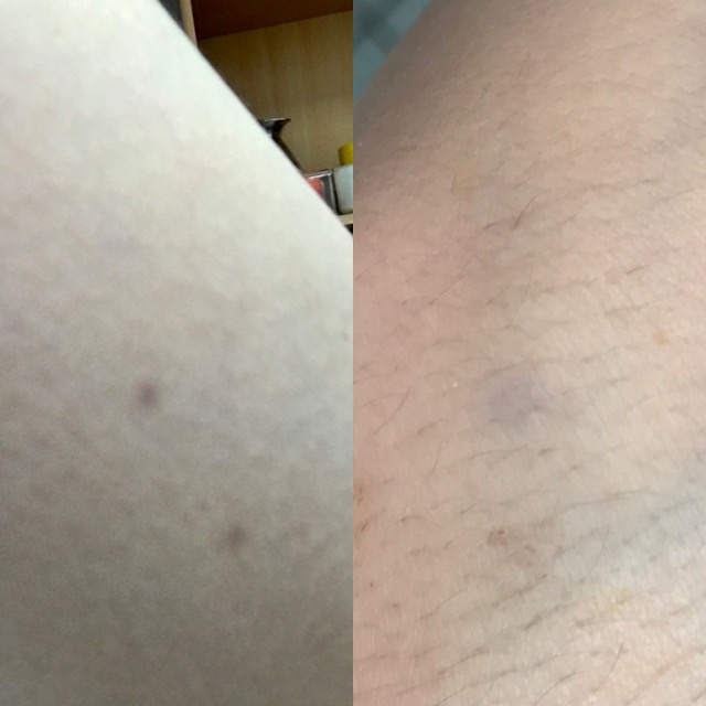 Was sind das für lila Punkte auf meinem Arm? (Haut, Dermatologie, Flecken)